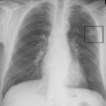 Allergies May Lower Lung Cancer Risk, Study Finds