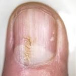 Dark Nail Lines May Signal Hidden Heart Infection