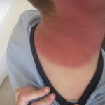 Surrey Residents Warned: Treat Sunburn Seriously, Says Expert